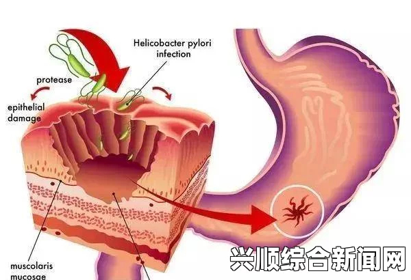 幽门螺杆菌根治方法及结尾处问题解答