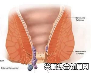 痔疮是一种常见的肛门疾病，通常由肛门和直肠区域的静脉曲张引起。这些曲张的静脉形成肿块，称为痔疮结节或痔核。痔疮可以出现在肛门内部或外部，或者同时出现在肛门内外。