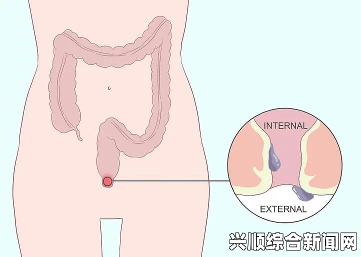 痔疮是一种常见的肛门疾病，通常由肛门和直肠区域的静脉曲张引起。这些曲张的静脉形成肿块，称为痔疮结节或痔核。痔疮可以出现在肛门内部或外部，或者同时出现在肛门内外。