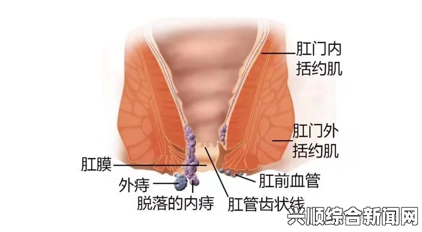 痔疮是一种常见的肛门疾病，通常由肛门静脉曲张引起。痔疮的症状多种多样，可能因个体差异而有所不同。以下是关于痔疮的详细症状描述及结尾处的问题解答环节。