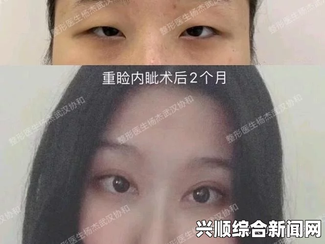 吴艳妮回应整容传闻，只割了双眼皮，下巴确实没整