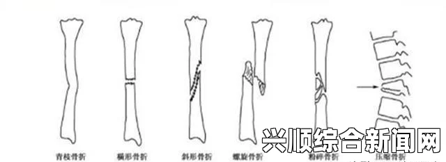 骨科兄弟，能否通过干湿程度来区分和修复骨折部位？